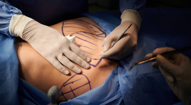 Abdominoplastia Mulher Mamanguape - Abdominoplastia Circunferencial