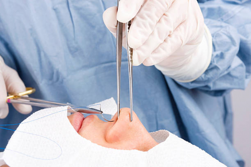 Cirurgia de Nariz Bairro Indústrias - Cirurgia de Rinoplastia Estruturada