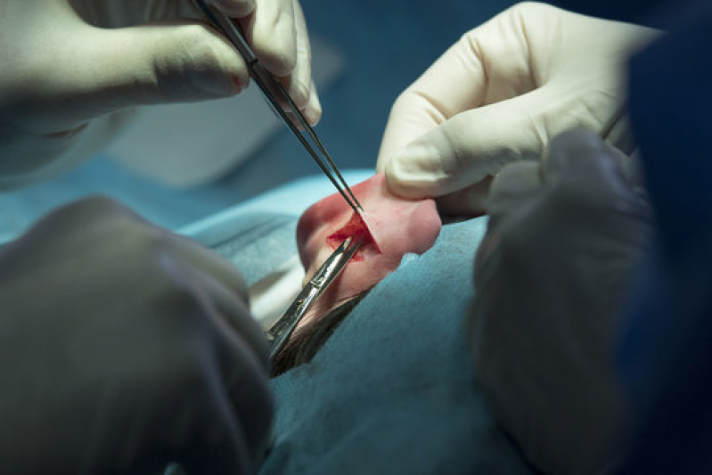 Cirurgia de Redução de Orelha Cuia - Cirurgia de Lobuloplastia
