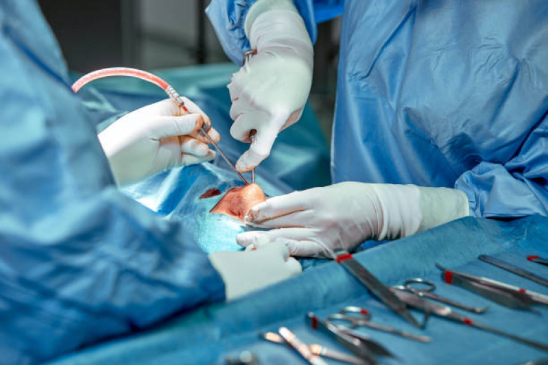 Cirurgia para Nariz Marcar Massaranduba - Cirurgia de Rinoplastia Masculina