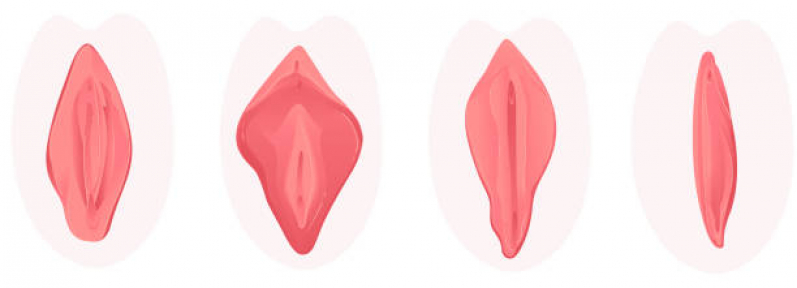 Cirurgia Pequenos Lábios Alto do Céu - Cirurgia Plástica íntima