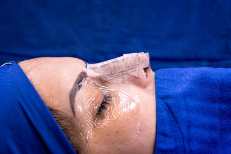 Cirurgia Rinoplastia Marcar Oitizeiro - Cirurgia para Diminuir o Nariz
