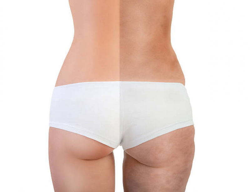 Contorno Corporal Feminina Marcar Água Branca - Contorno Corporal para Excesso de Gordura