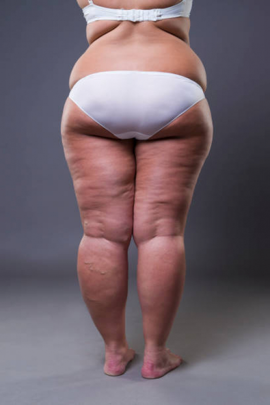 Contorno Corporal para Gordura em Excesso João Pessoa - Contorno Corporal para Excesso de Gordura