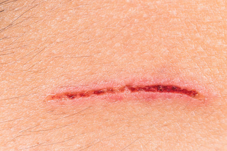 Correção Cicatriz Cesarea Cajazeiras - Correção Reparadora de Cicatriz