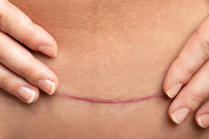 Correção de Cicatriz Abdominoplastia Gramame - Correção de Cicatriz no Umbigo