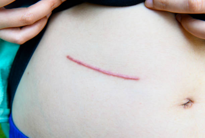 Correção de Cicatriz de Abdominoplastia Itatuba - Correção de Cicatriz Abdominal