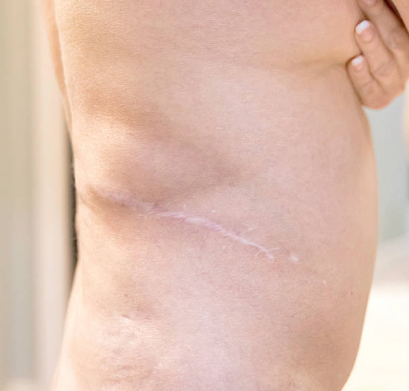 Correção de Cicatriz de Cesárea Marcar Cordão Encarnado - Correção de Cicatriz no Umbigo