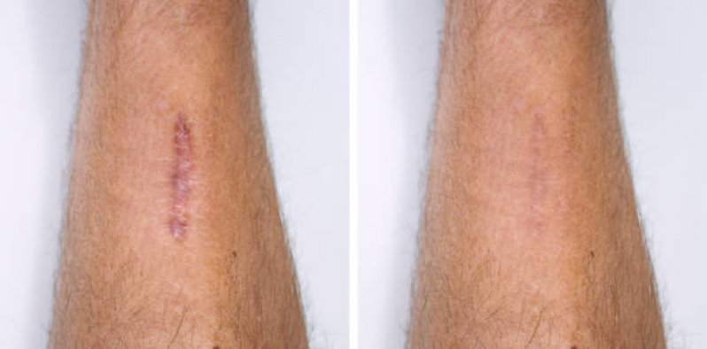 Correção de Cicatriz Mamoplastia Brisamar - Correção de Cicatriz no Umbigo