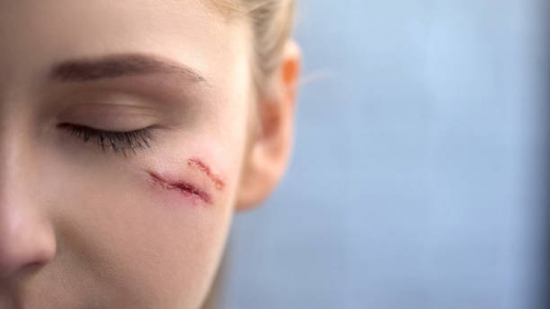 Correção de Cicatriz no Rosto Mamanguape - Correção de Cicatriz Abdominoplastia