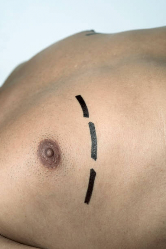 Ginecomastia Bilateral Masculina Queimadas - Ginecomastia para Homens