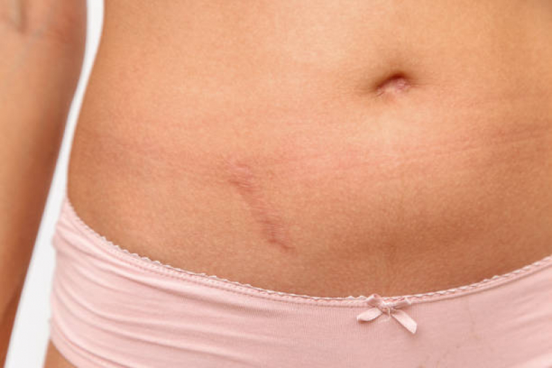 Onde Faz Correção de Cicatriz de Abdominoplastia Muçumagro - Correção de Cicatriz de Mastopexia