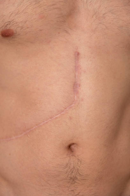 Onde Faz Correção de Cicatriz Mamoplastia Brisamar - Correção Reparadora de Cicatriz Campina Grande