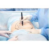 abdominoplastia feminina clínica Tambia