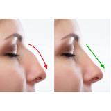 cirurgia para correção de nariz marcar Centro