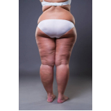 contorno corporal para gordura em excesso Aroeiras