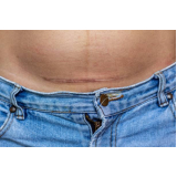 correção de cicatriz abdominoplastia marcar Miramar