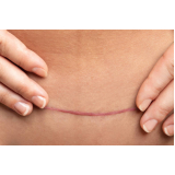 correção de cicatriz abdominoplastia Renascer II