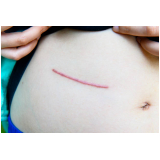correção de cicatriz de abdominoplastia Loteamento Quadra Mares